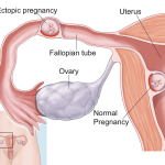 Ectopic pregnancy