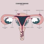 Endometriosis